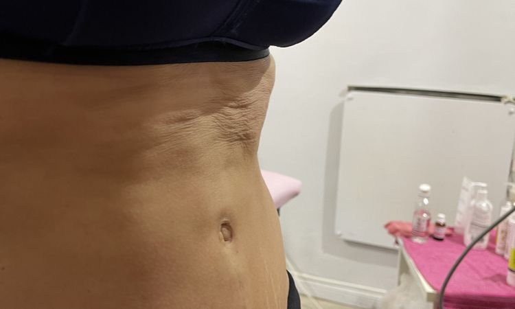 Corregir fibrosis a 5 meses de abdominoplastia con morpheus8 - 52179