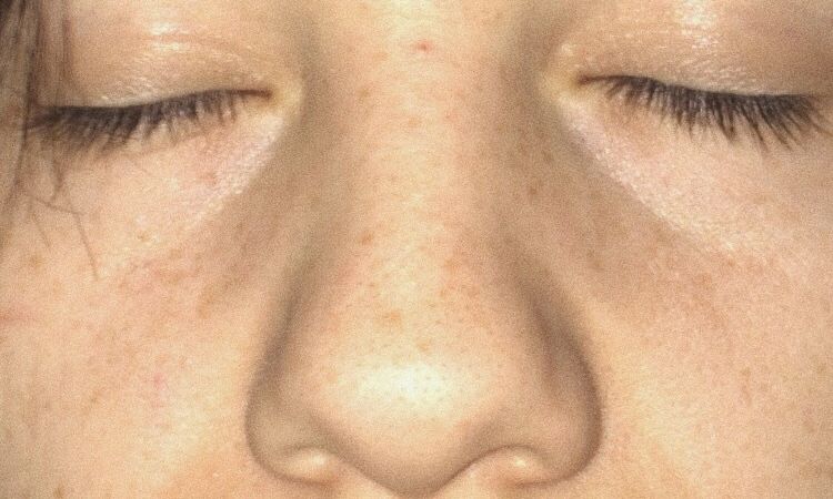 Mi rinoplastia será abierta o cerrada? - 52433