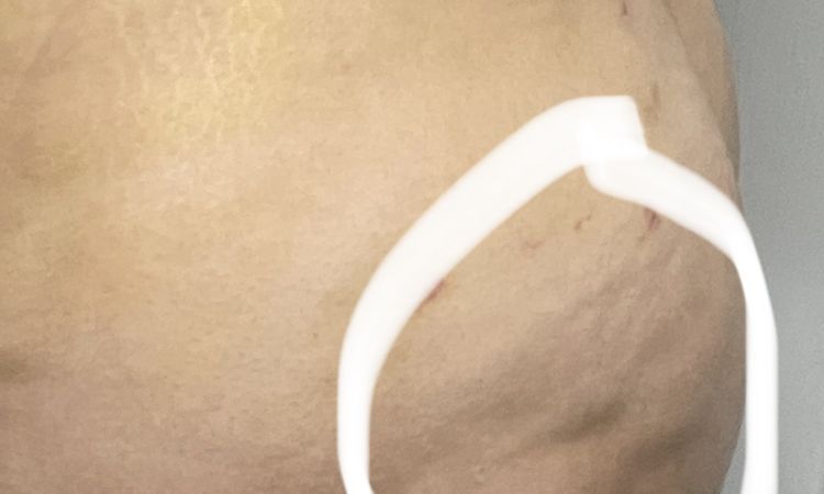 Calambres en un glúteo post liposucción 360 y lipotransferencia - 52443