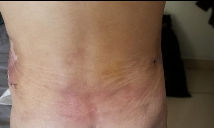 Dolores terribles 3 meses tras abdominoplastia y lipo en espalda - 52650