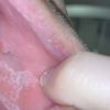 Mejillas internas blancas tras 5 meses de mi bichectomía