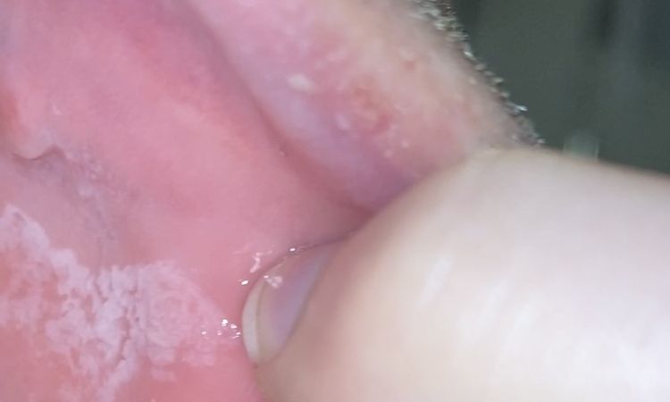 Mejillas internas blancas tras 5 meses de mi bichectomía - 53271