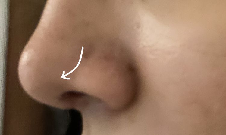 Rinoplastia tras 1 mes de cirugía ¿Inflamación o retracción? - 53567