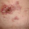 Heridas abiertas tras 2 meses abdominoplastia