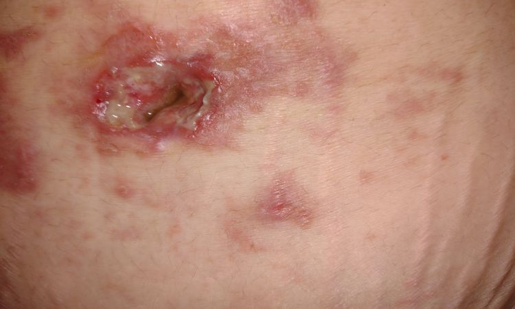 Heridas abiertas tras 2 meses abdominoplastia - 53784