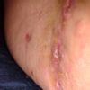 Heridas abiertas tras 2 meses abdominoplastia