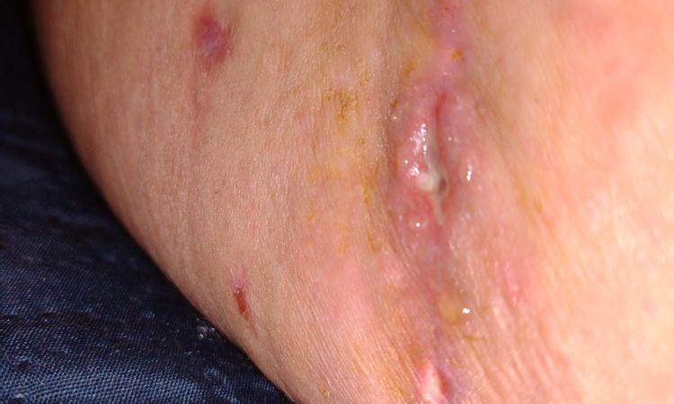 Heridas abiertas tras 2 meses abdominoplastia - 53785