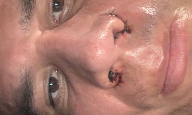 La punta de mi nariz se mueve a tumbarme de lado tras rinoseptoplastia - 54264