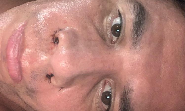 La punta de mi nariz se mueve a tumbarme de lado tras rinoseptoplastia - 54266
