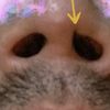 Corregir sinequia en fosa nasal - 54274