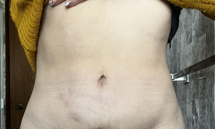 Mejorar abdomen post liposucción - 54679