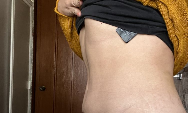 Mejorar abdomen post liposucción - 54680