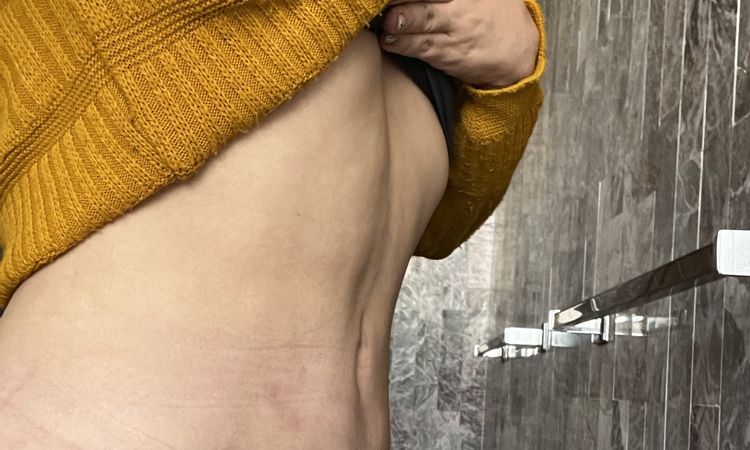 Mejorar abdomen post liposucción - 54681