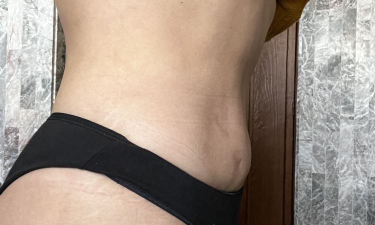 Mejorar abdomen post liposucción - 54682