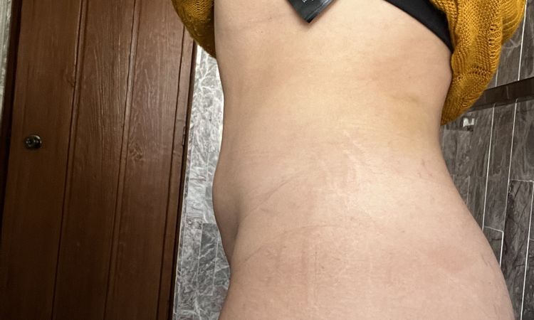 Mejorar abdomen post liposucción - 54684
