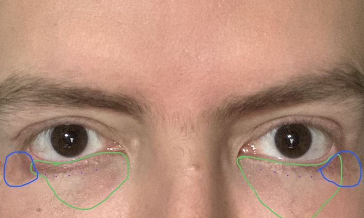 Lipofilling o Ácido Hialurónico para rellenar ojeras y pómulos - 54823