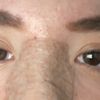 Bolsas y ojeras tras blefaroplastia inferior - 54892