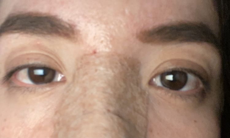 Bolsas y ojeras tras blefaroplastia inferior - 54892