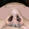 Reconstrucción fosa nasal tras dos rinoplastias