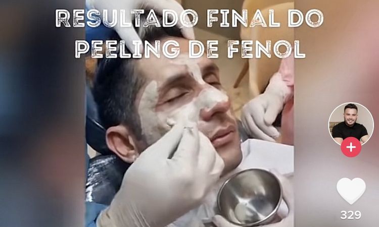 Peeling fenol para cicatrices de acné - 55092