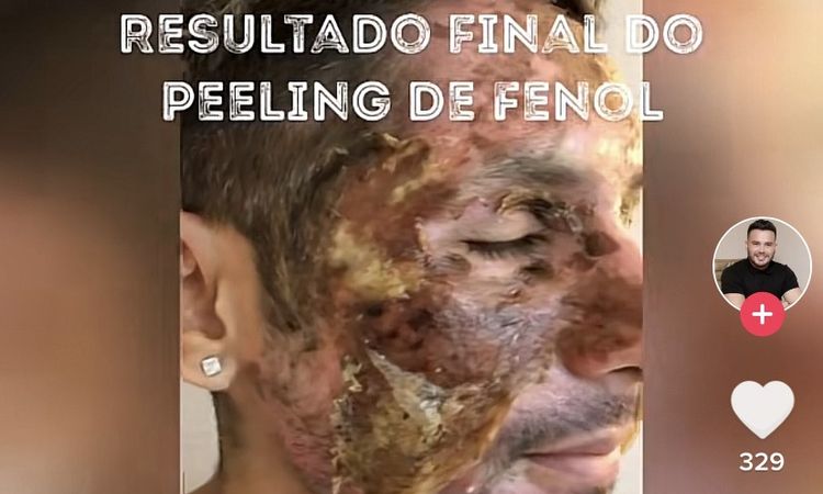 Peeling fenol para cicatrices de acné - 55093