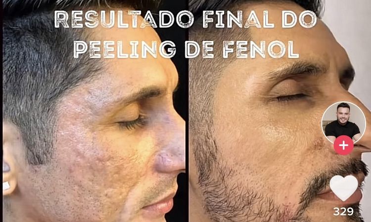 Peeling fenol para cicatrices de acné - 55094