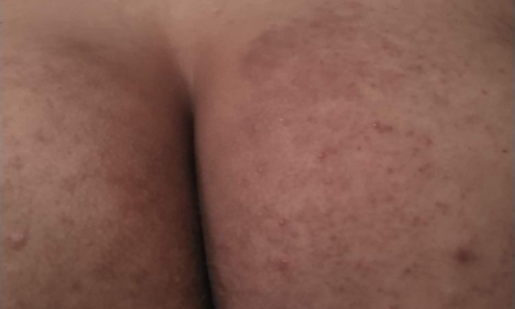 Tratar quemadura con ácido para verrugas - 55223