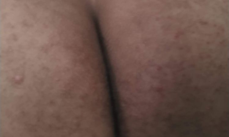 Tratar quemadura con ácido para verrugas - 55224