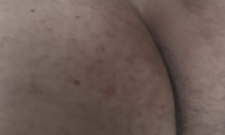 Tratar quemadura con ácido para verrugas - 55225