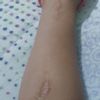 ¿Se puede disimular esta cicatriz con algun tratamiento?