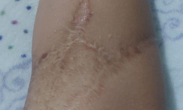 ¿Se puede disimular esta cicatriz con algun tratamiento? - 55546
