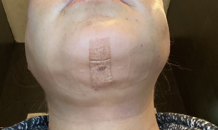 Lonjita flácida después de una lipopapada láser - 55926