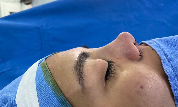 Nariz igual de ancha y chata tras rinoplastia ¿Cómo proceder? - 57007