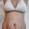 Alternativas no quirúrgicas para flacidez en abdomen