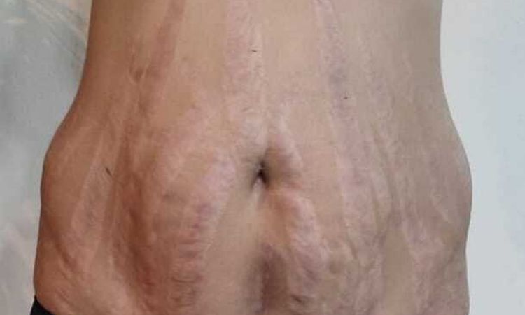 Alternativas no quirúrgicas para flacidez en abdomen - 57475
