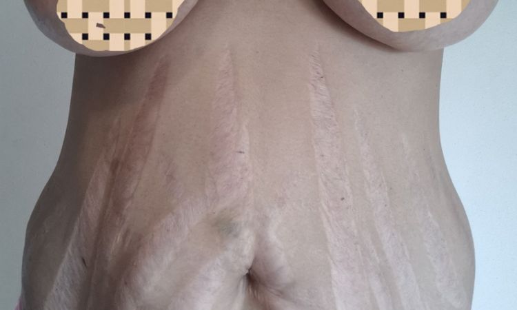 Alternativas no quirúrgicas para flacidez en abdomen - 57477