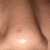 Tratamiento láser o peeling post cauterización de un vaso sanguíneo roto