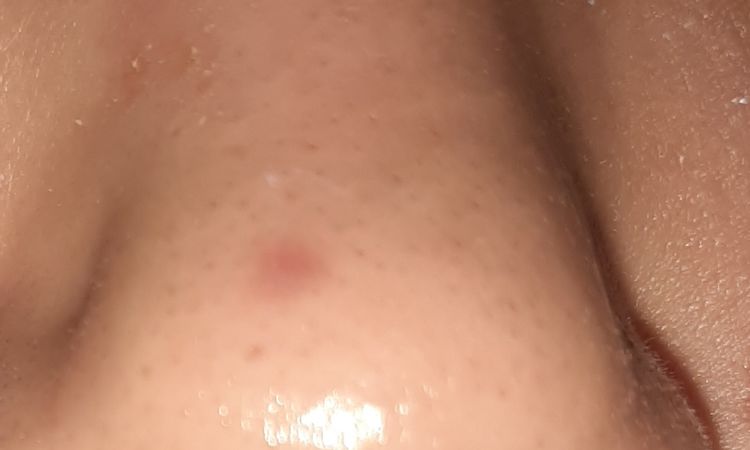 Tratamiento láser o peeling post cauterización de un vaso sanguíneo roto - 57626