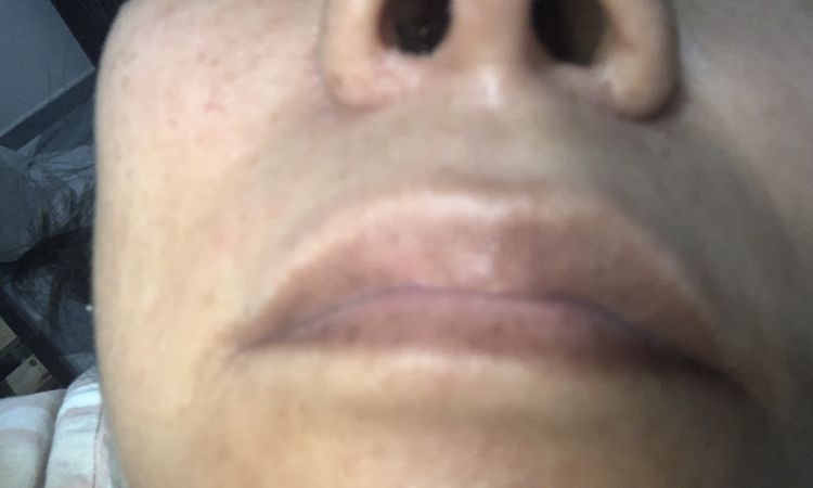 Corregir cicatrices por rinoplastia tras 4 años - 57635