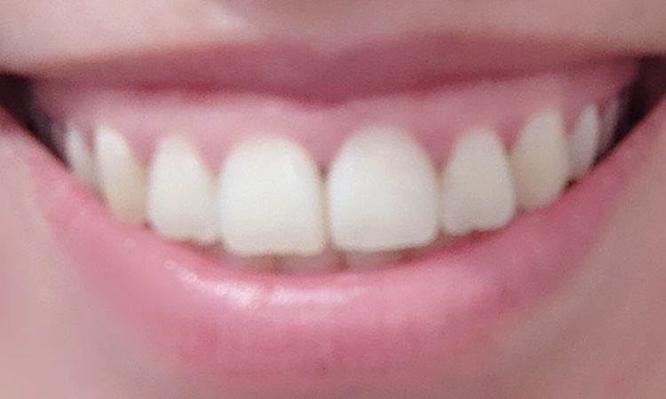 ¿Cómo corregir sonrisa gingival? - 57850