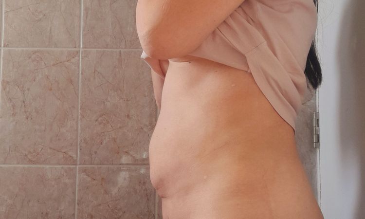 Inflamación de vientre dos semanas después de Liposucción Mela - 58050
