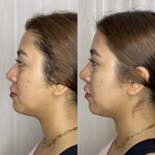 Resultados permanentes de lipopapada con HIFU con enzimas y radiofrecuencia