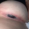 Implante expuesto. ¿Me tengo que operar de emergencia?