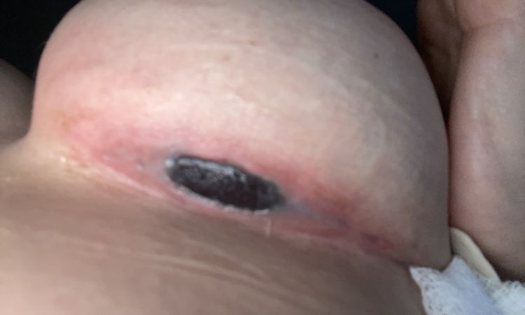Implante expuesto. ¿Me tengo que operar de emergencia? - 58480