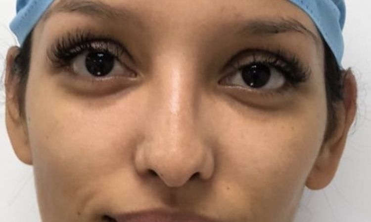 Tratamiento para colapso alar tras rinoplastia - 58548