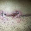 Punto de abdominoplastia que no cierra tras 1 mes y 2 semanas