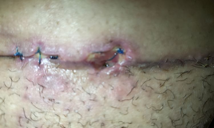 Punto de abdominoplastia que no cierra tras 1 mes y 2 semanas - 58568