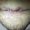 Punto de abdominoplastia que no cierra tras 1 mes y 2 semanas