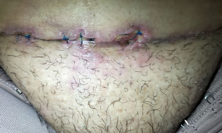 Punto de abdominoplastia que no cierra tras 1 mes y 2 semanas - 58569