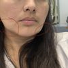 Descolgamiento facial tras bichectomía y lipopapada